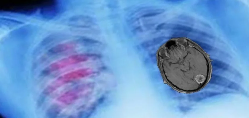 Akciğer Kanserinde Beyin Metastazı Neden Olur?