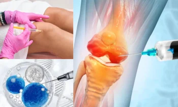 Kitosan Tedavisi Nedir ve Nasıl Uygulanır?