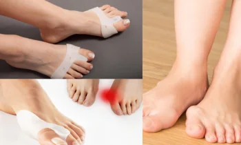 Halluks Valgus Oluşum Nedenleri ve Korunma Yolları