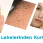 Güneş Lekelerinden Nasıl Kurtuluruz
